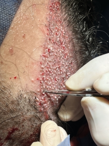 Greffe Capillaire : Technique AFUE contre l'alopécie près de Chambéry