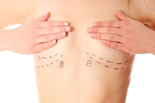 Augmentation mammaire par transferts graisseux, lipostructure, Grenoble