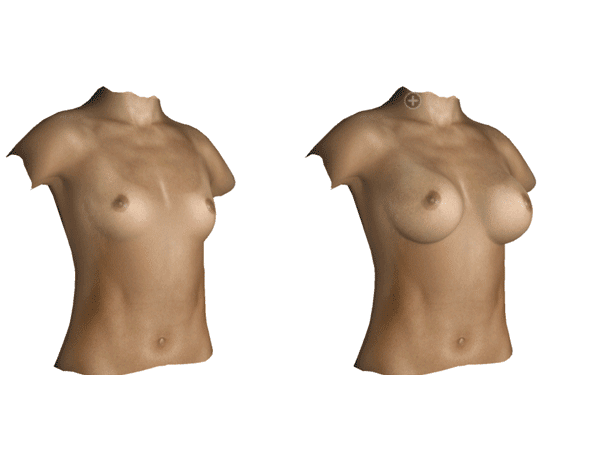 Animation 3D de chirurgie esthétique des seins à Grenoble et Meylan
