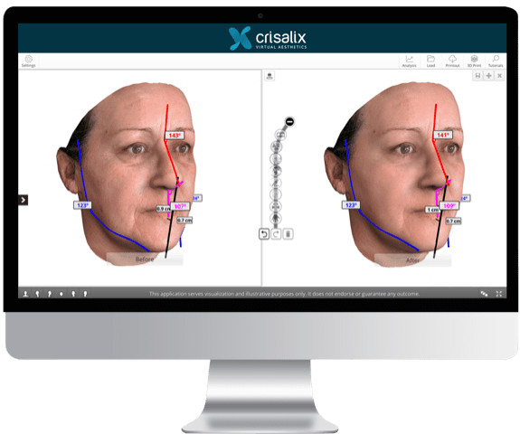 Photo de simulation 3D de rhinopastie - Chirurgie du visage