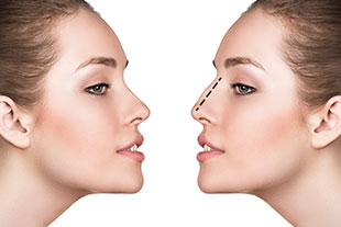 Rhinoplastie, chirurgie esthétique du nez